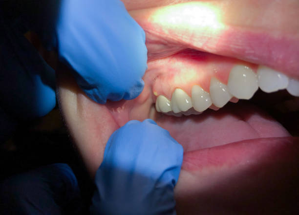 Best Emergency Denture Repair in Ashtabula, OH